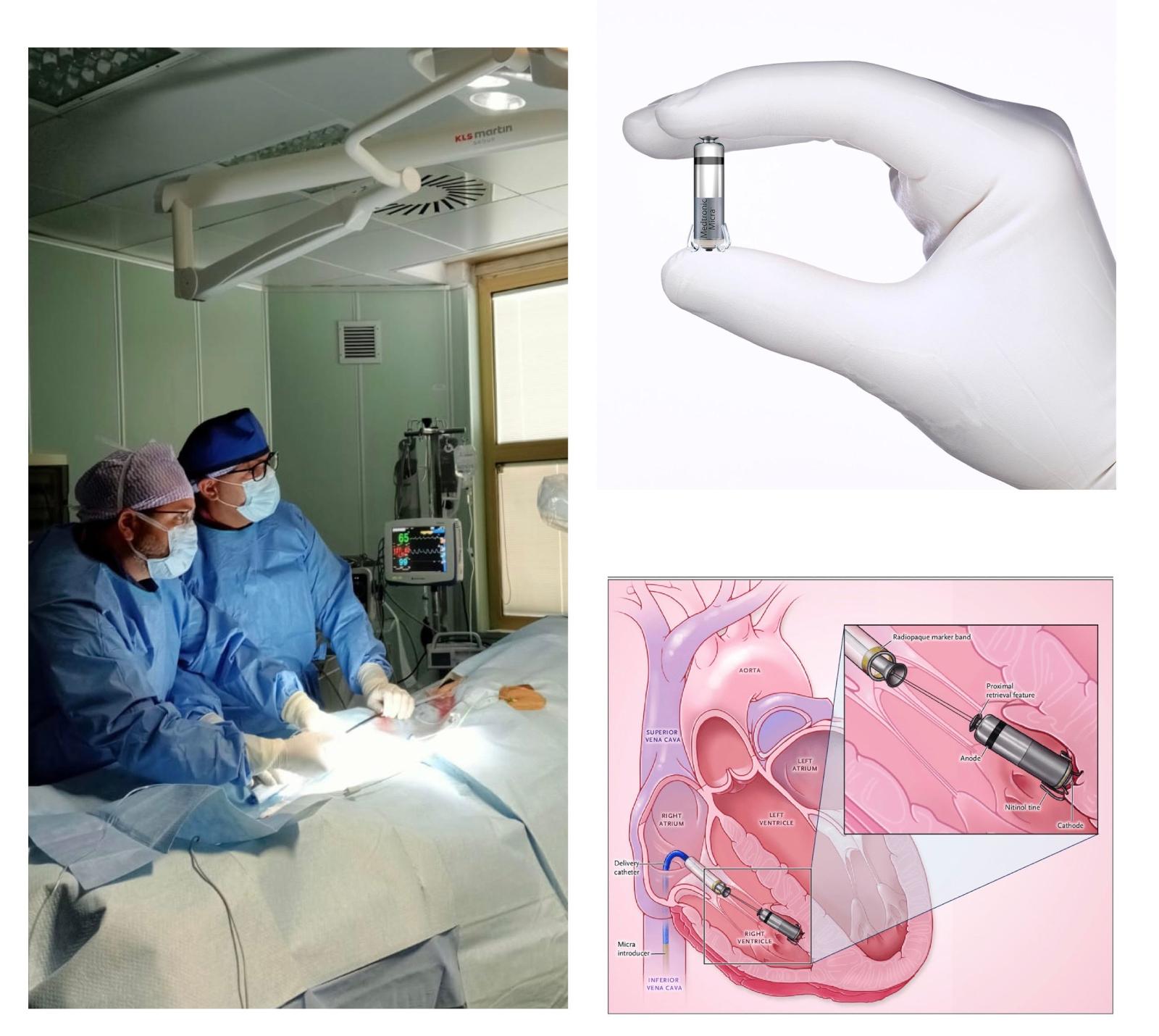 Il primo impianto di pacemaker senza fili della Cardiologia dell’ospedale Mazzoni